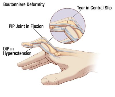 jammed knuckle treatment