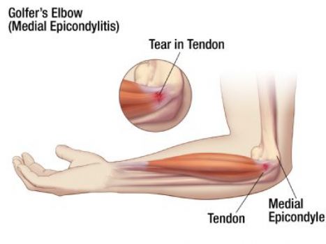 Medial Epicondylitis (Golfer's