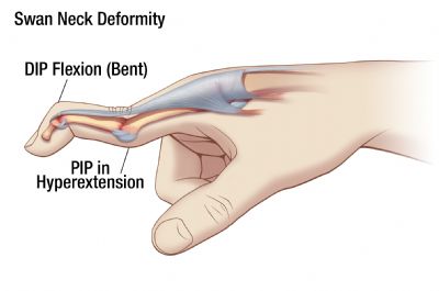 Swan Neck Deformity picture showing hyperextended PIP and flexed DIP joint