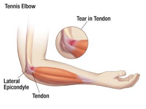 elbow pain