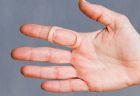 Oval-8 finger splint for treating trigger finger by preventing the finger from bending to the point of triggering