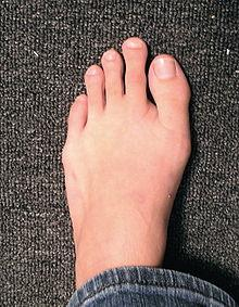 3pp crooked toes blog part 1 resized 600