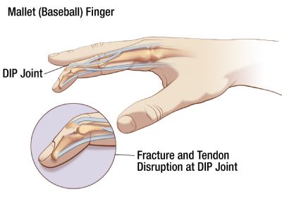 Mallet Finger