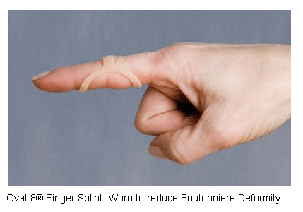Oval-8 Finger Splint used to treat a boutonniere deformity