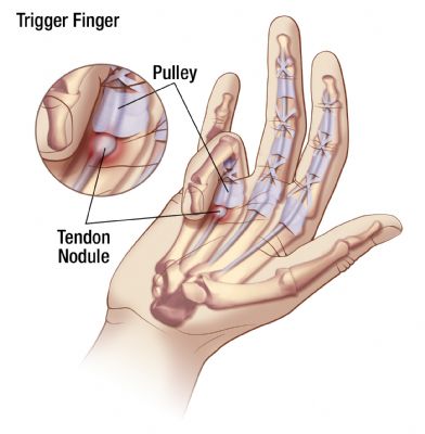 Trigger thumb illustration