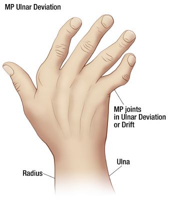deviation ulnar osteoarthritis ra hand arthritis drift ulna fingers wrist hands nodes heberden vs where condition