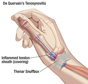 deQuervain's tenosynovitis illustration