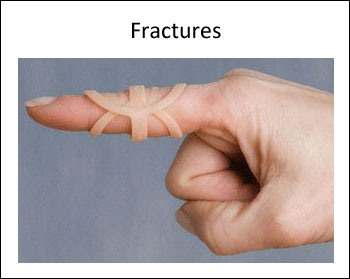 Use an Oval-8 to treat finger fractures