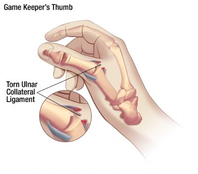 Gamekeeper's Thumb or Skier's Thumb injury illustration