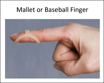 Use an Oval-8 to treat mallet or baseball finger