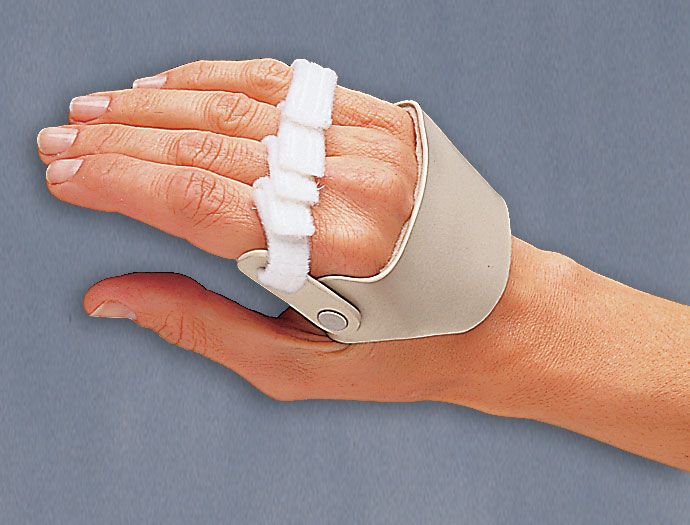 Radial hinged ulnar  deviation splint helps correct strongly deviated fingers.
