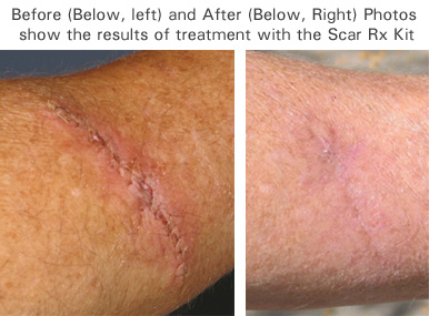 scar rx before after
