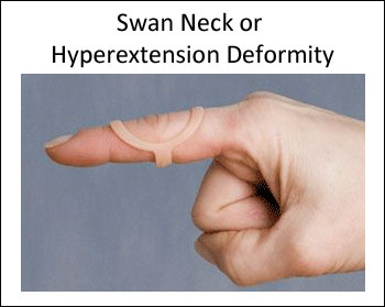 Use an Oval-8 to treat Swan Neck or Hyperextension deformity 