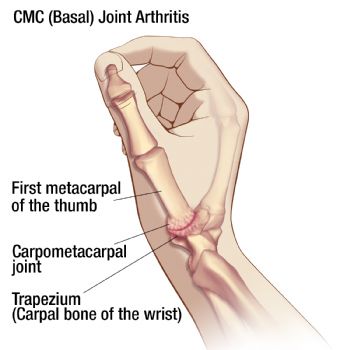 CMC basal joint arthritis illustration