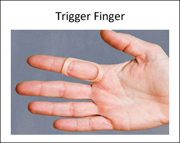 Use an Oval-8 to treat trigger finger