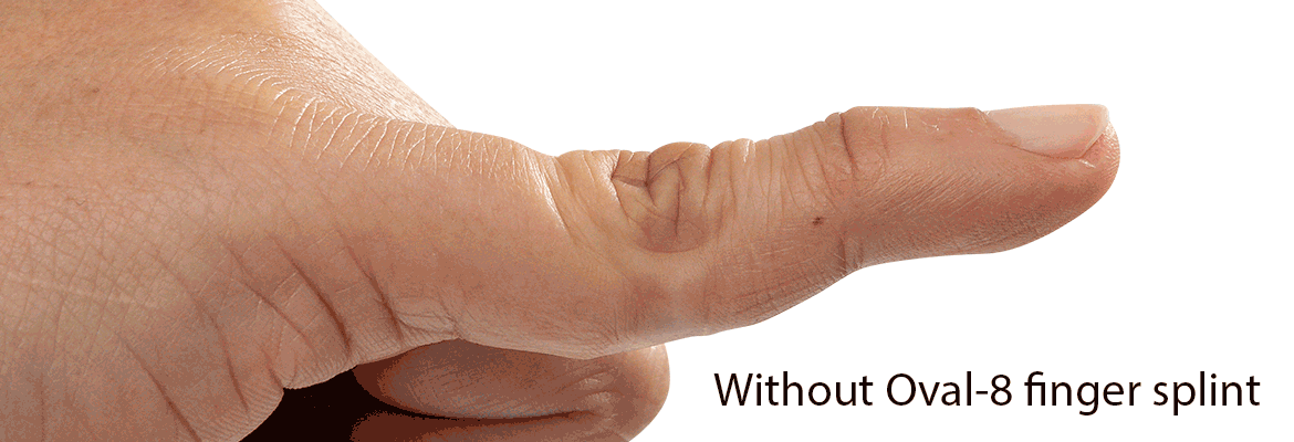 The Original Oval-8 Finger Splints | 3-Point Products