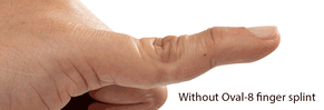 oval-8 finger splint for swan neck deformity