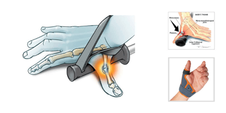 Skier’s Thumb: A Hazard of Hitting the Slopes