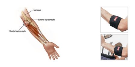 Medial Epicondylitis - Diagnosis & Treatment