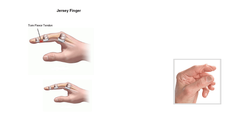 Using a Finger Splint to Treat Trigger Finger-Updated January 2024