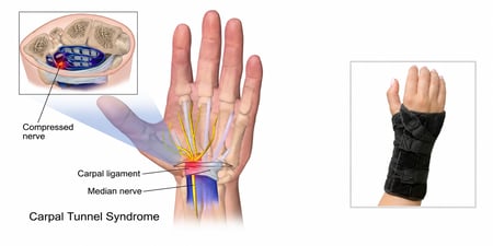 Carpal tunnel syndrome illustration showing median nerve compression alongside a Choice Wrist Brace for wrist immobilization.