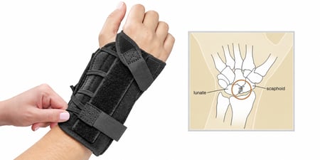 Choice Wrist Brace worn for wrist immobilization alongside an illustration of the scaphoid and lunate bones for scapholunate ligament injury.