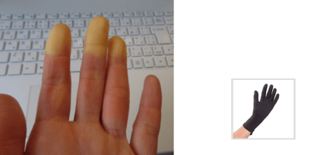 Summertime and Raynaud's Syndrome
