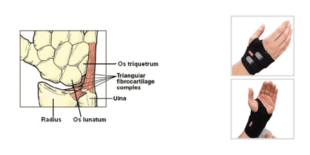 TFCC Ulnar Sided Wrist Pain - Anatomy, Diagnosis & Treatment