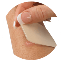 Gel mate silicone scar sheets