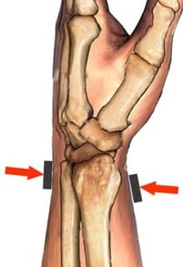 orthotic design