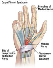 Carpal Tunnel Syndrome lumbricals