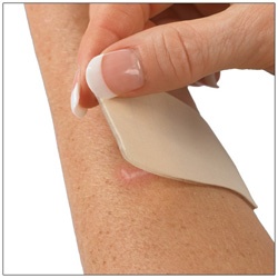 Gel Mate silicone gel sheeting for scar management