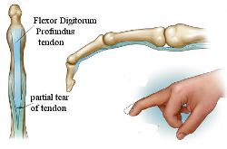 jersey finger a common contact sport injury