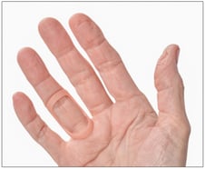 oval 8 finger splint for trigger finger