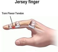 what is jersery finger and how to treat it