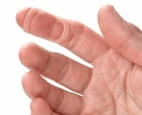 oval-8 finger splints for treating jersey finger