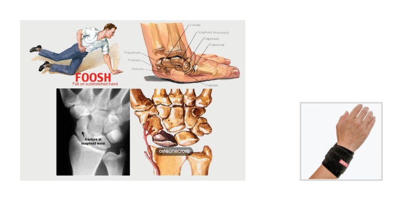 Wrist Pain after a Fall on an Outstretched Hand (FOOSH)