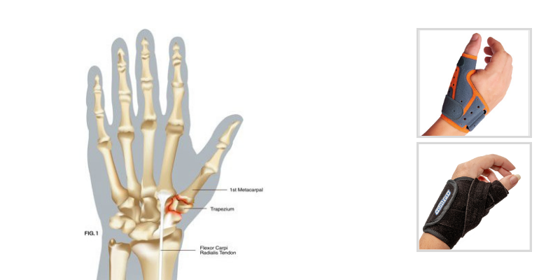 What’s New with an Old Diagnosis? Exercises for TMC Arthritis