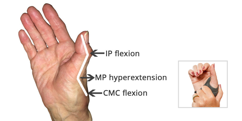 How to Manage a Thumb Deformity from Rheumatoid Arthritis
