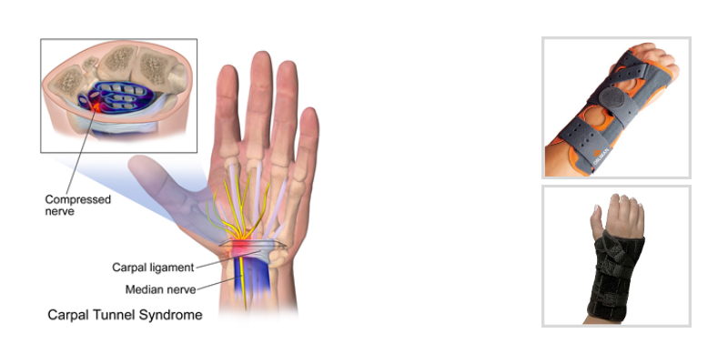 Carpal Tunnel Release Surgery - Endoscopic vs Mini Open