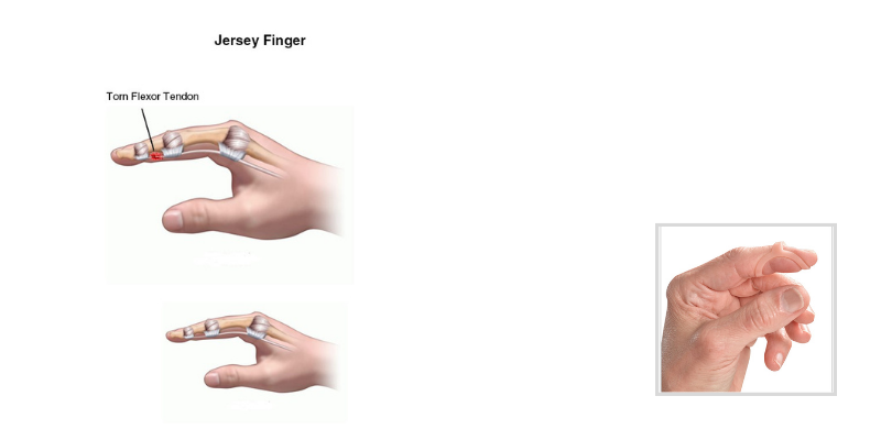 Jersey Finger: Treatment For a Common Contact Sport Injury