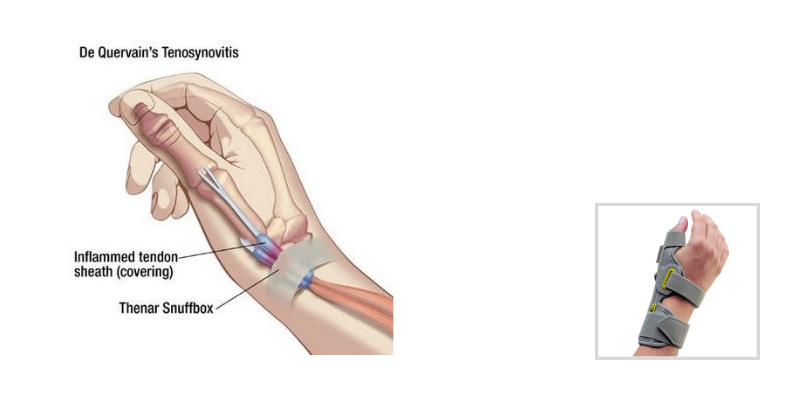 De Quervain’s Tenosynovitis - What’s New About An Old Condition?