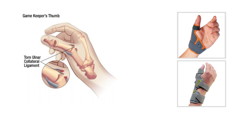 Ulnar Collateral Ligament Injury of the Thumb