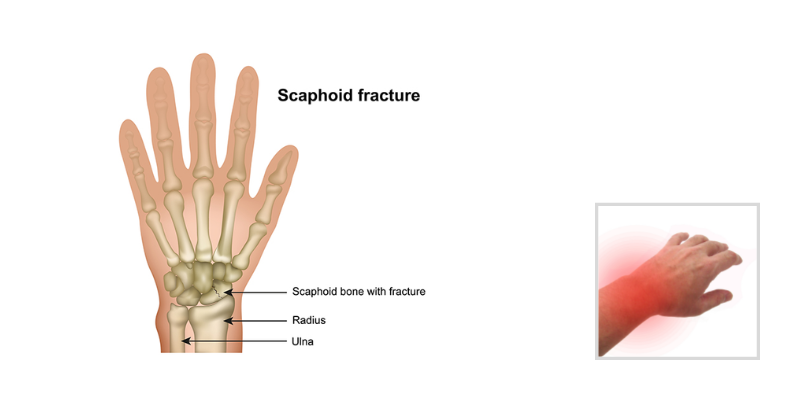 Scaphoid Fractures - Treatment and Rehabilitation