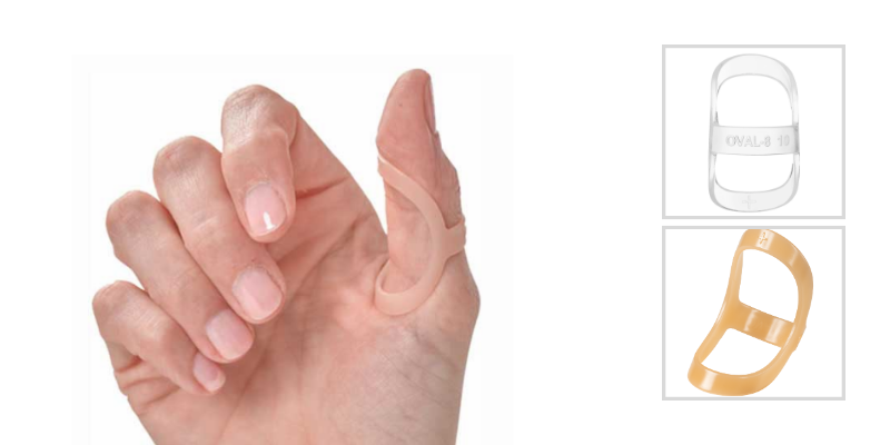 Treating Trigger Thumb with an Oval-8 Finger Splint