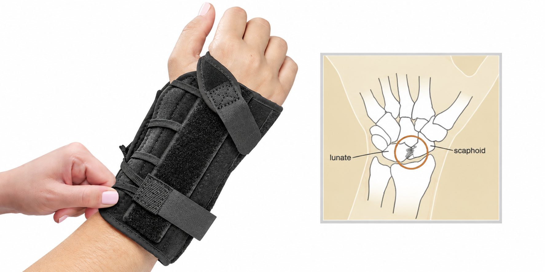 Conservative Treatment of Scapholunate Ligament Injury