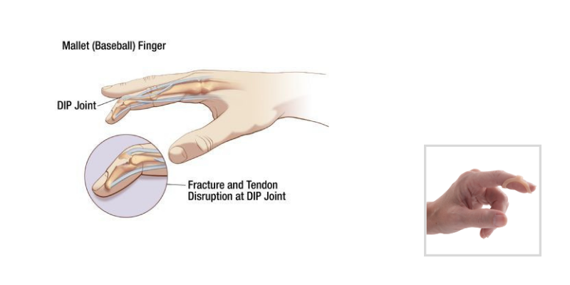 Mallet Finger - A Clinical Protocol