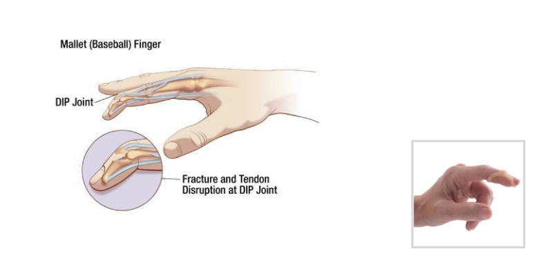 Finger Injuries, Finger Disorders