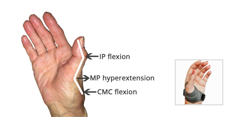 Treating CMC Joint Arthritis - Collapse Deformities of the Thumb