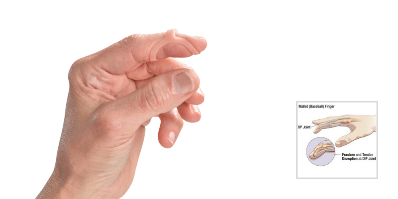 Treatment for Mallet Finger